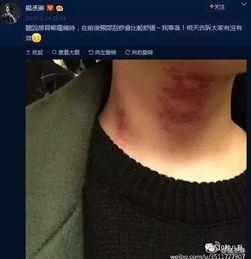 明星揪痧图,揭秘痧疗美容新潮流